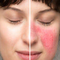 Redness Control